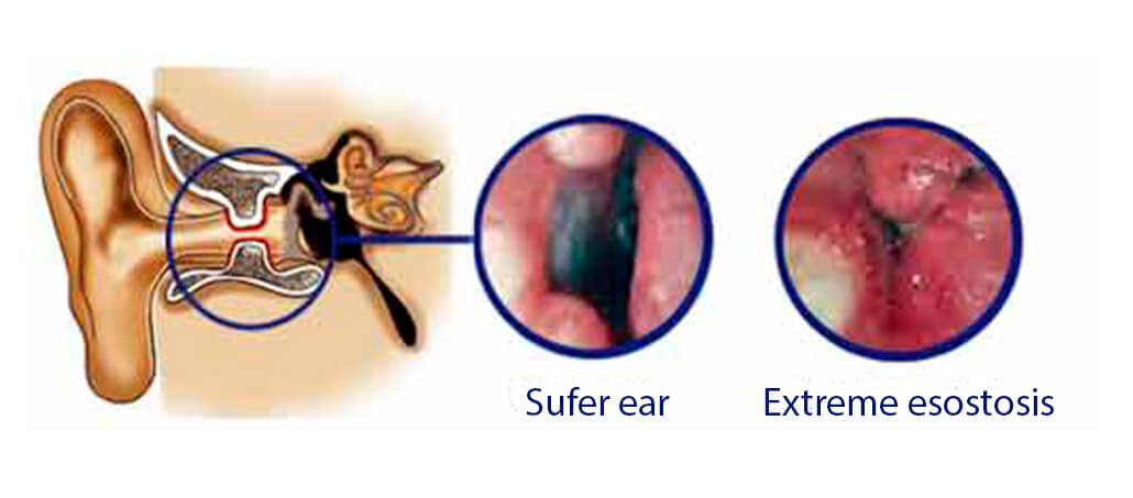 Diagram of the ear canal with comparison images showing surfer’s ear and extreme exostosis.